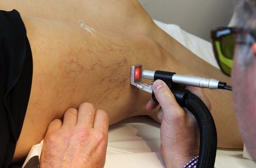 Radiazione laser