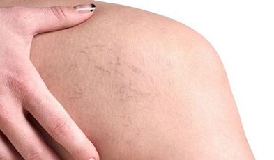 Come si manifestano le vene varicose nelle donne