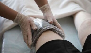 Metodi folk per il trattamento delle vene varicose nelle donne