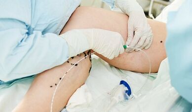 Metodi per il trattamento delle vene varicose sulle gambe nelle donne