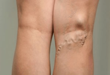 Diagnosi delle vene varicose nelle donne in gravidanza