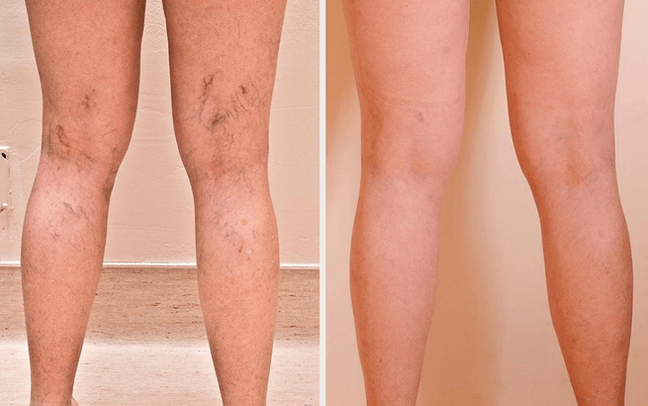gambe prima e dopo il trattamento delle vene varicose