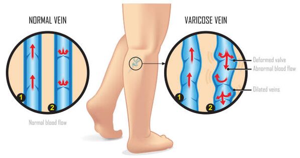 vene varicose degli arti inferiori
