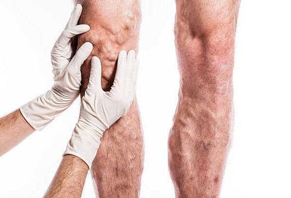 Palpazione delle vene varicose sulle gambe