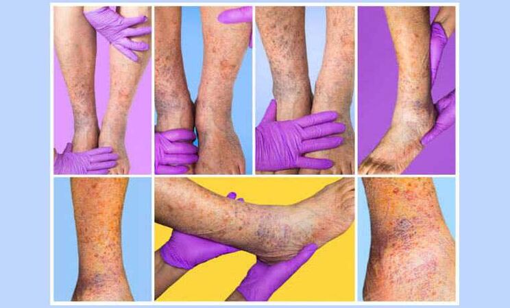 Un flebologo esamina gli arti inferiori di un paziente con vene varicose