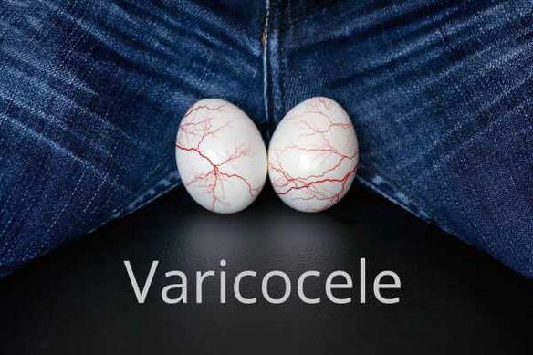 Varicocele - dilatazione delle vene del funicolo spermatico
